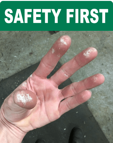 Hand affected by the chemical exposure described in this equipment safety example
